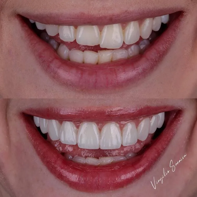 Antes e depois de caso de dentes escurecidos tratado com facetas em resina