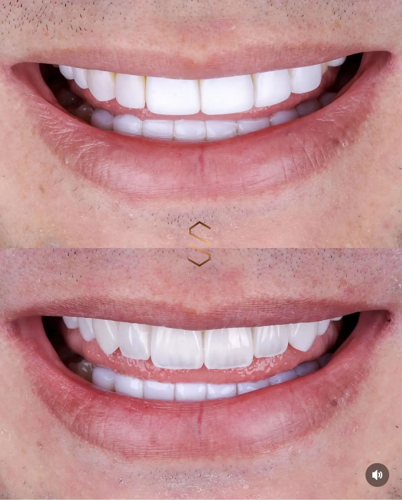 Antes e depois da estratificação de faceta em resina na região anterior